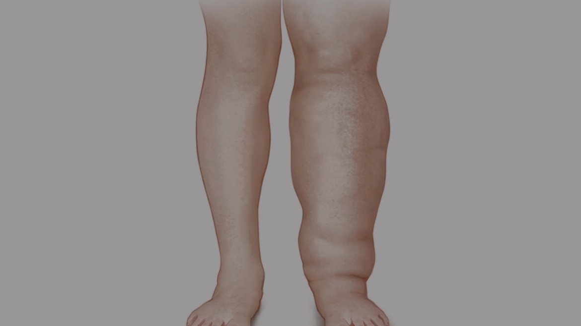 Lymphatic Drainage